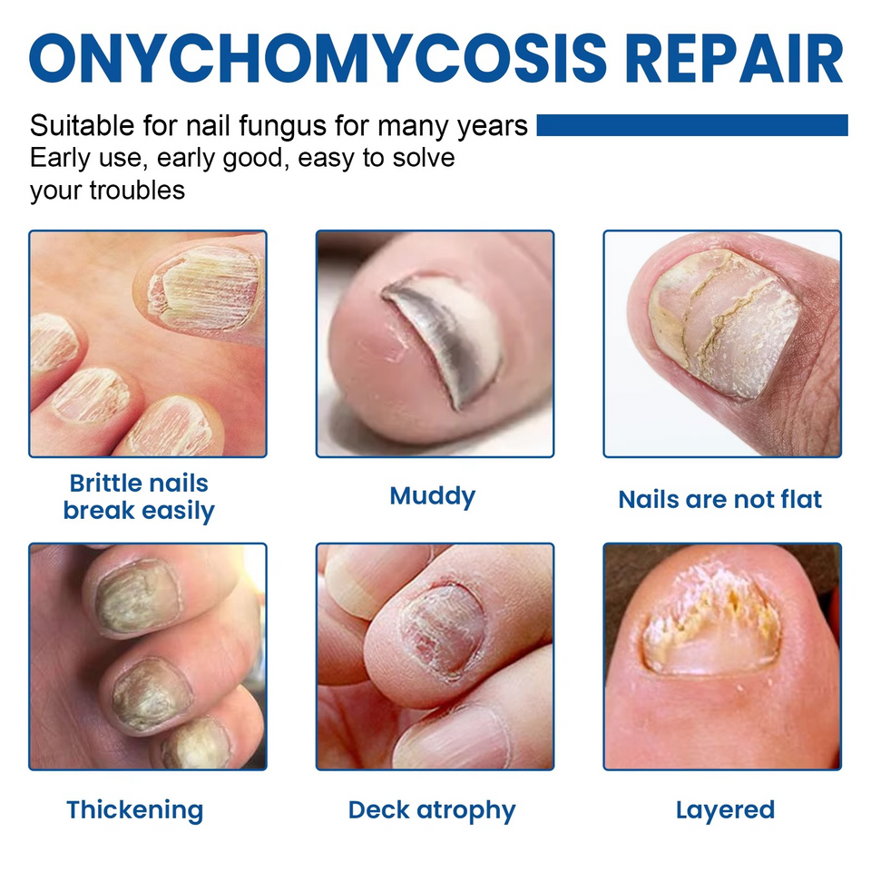 Fungal Nail Patches